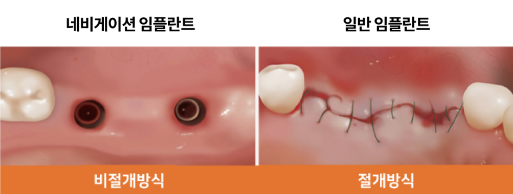 네비게이션 임플란트 vs 일반 임플란트