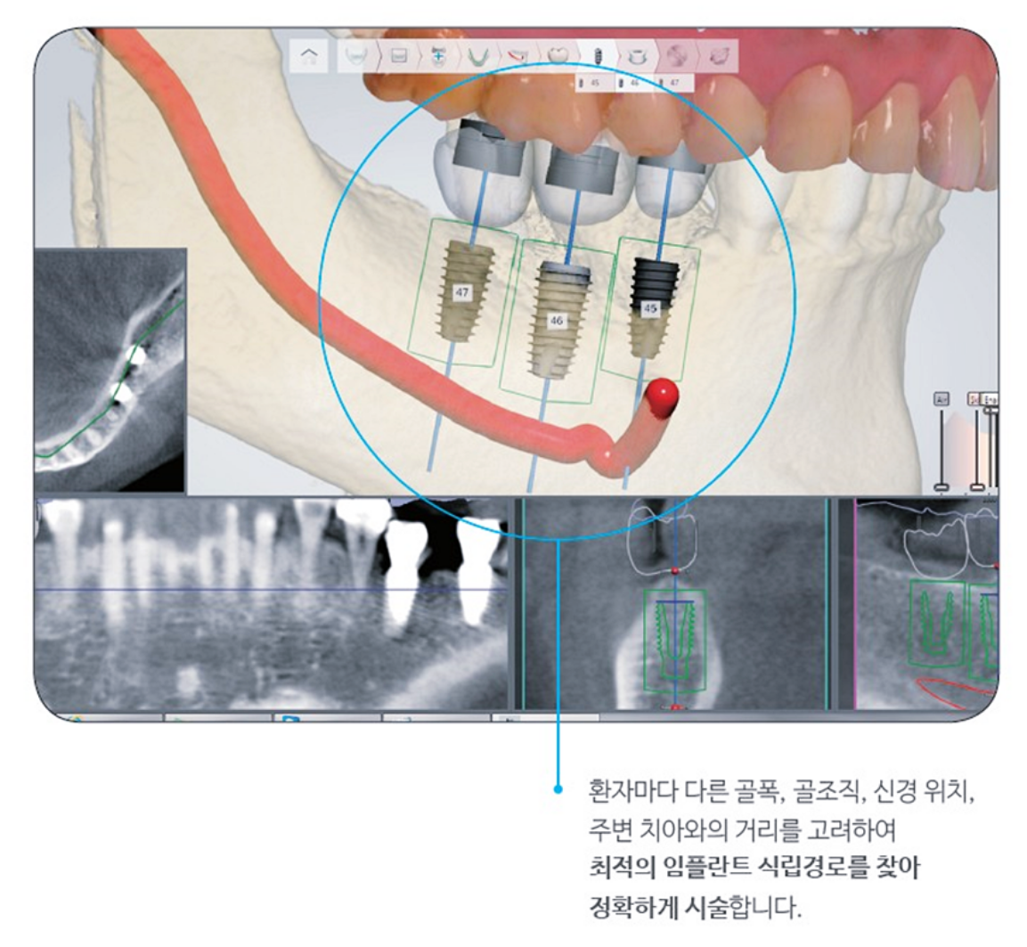최적의 임플란트 식립경로
