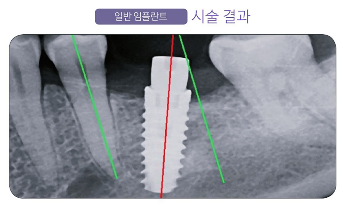 일반 임플란트 시술 결과