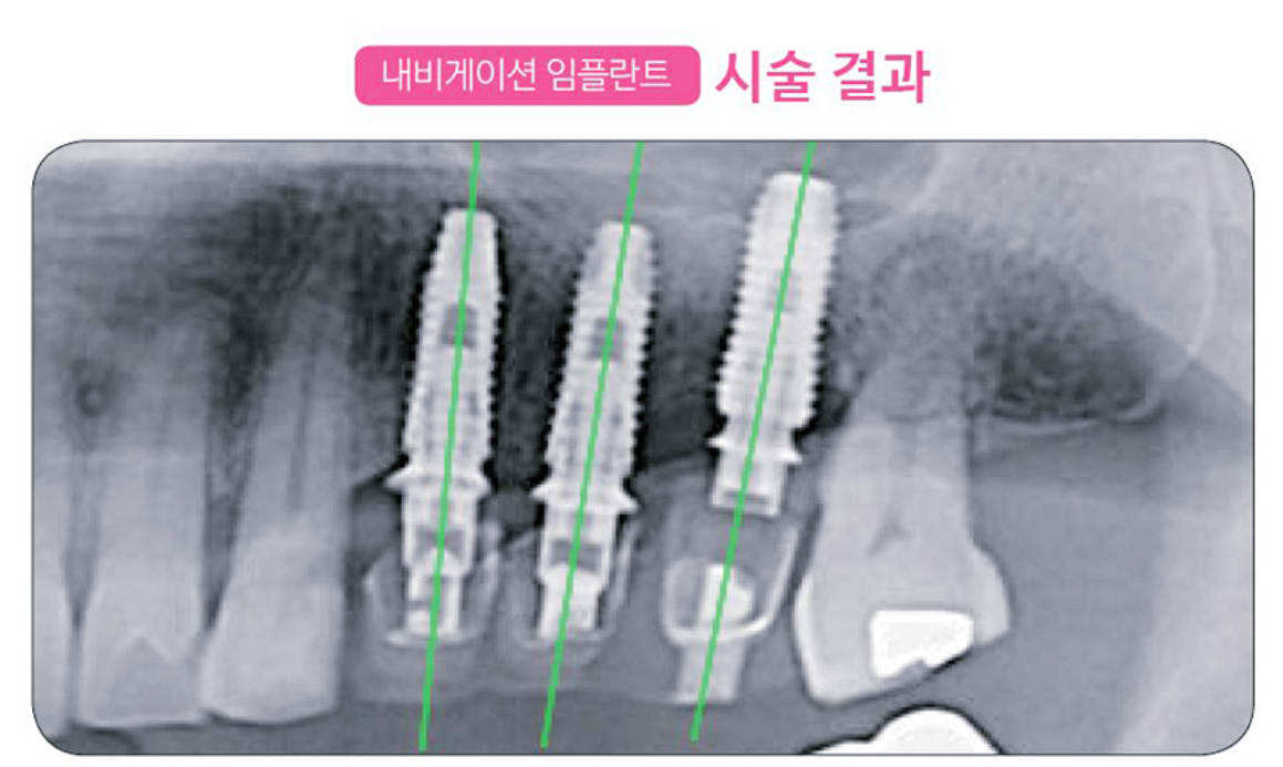 네비게이션 임플란트 시술 결과