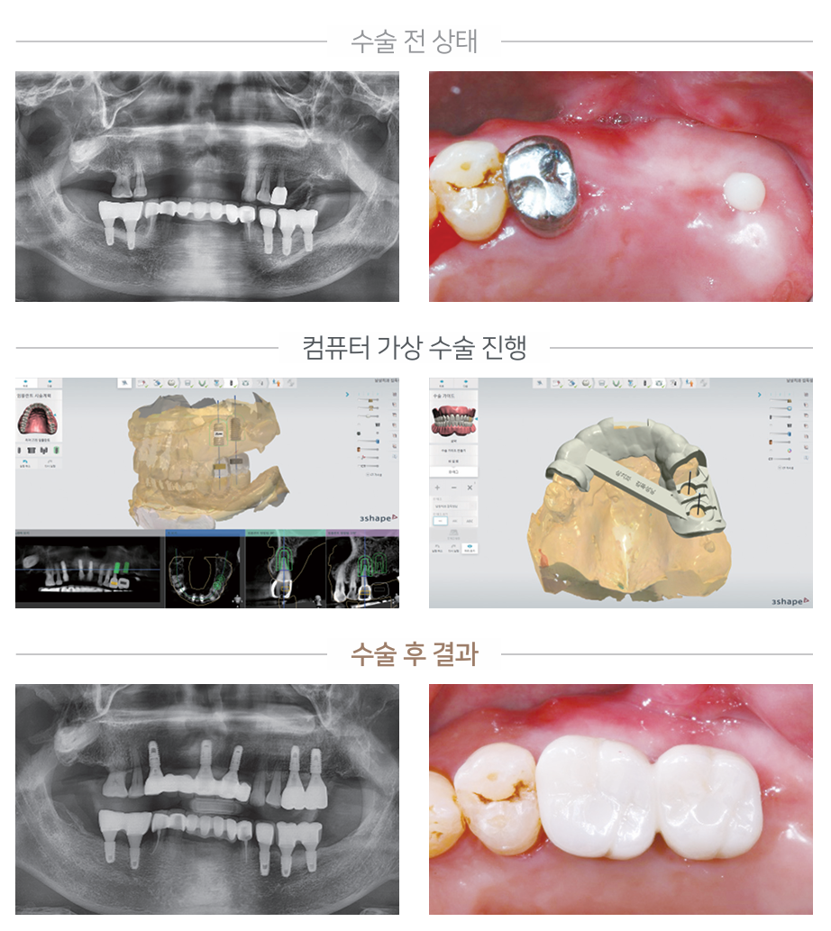 네비게이션 임플란트 케이스 2 - 수술 전/가상수술/수술 후