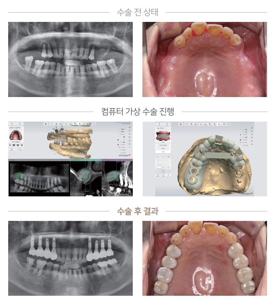 네비게이션 임플란트 케이스 3 - 수술 전/가상수술/수술 후