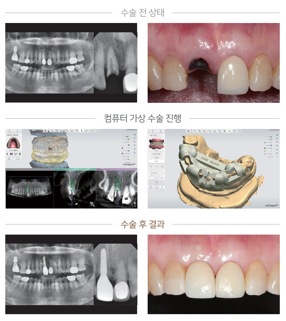 네비게이션 임플란트 케이스 4 - 수술 전/가상수술/수술 후