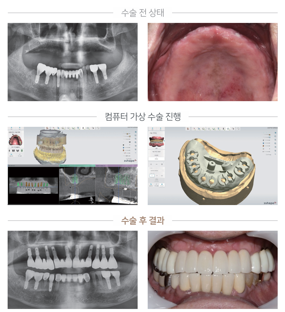 네비게이션 임플란트 케이스 5 - 수술 전/가상수술/수술 후