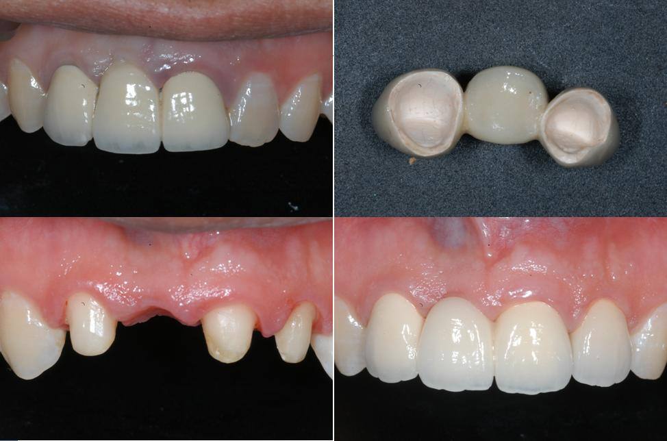 Zirconia 브릿지 증례
